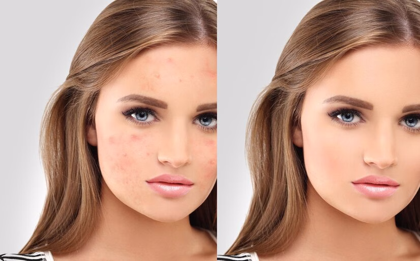 post acne marks treating acne scars acne scar removal 979672 525 1 jpg Fractional CO2 Laser Resurfacing