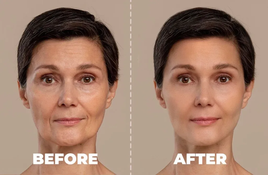 radiesse Before and After a Face Lift