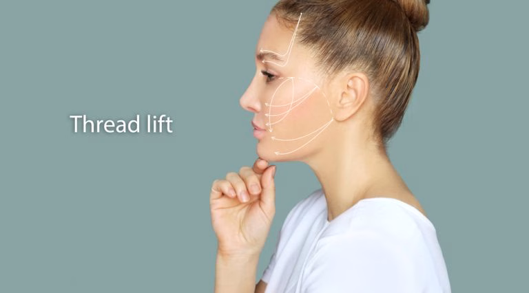 What you need to know about thread lifts