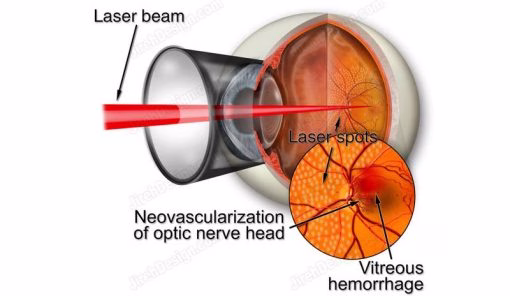 Argon Laser Diabetic Retinopathy