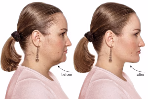Jawline PDO Threads Before and After