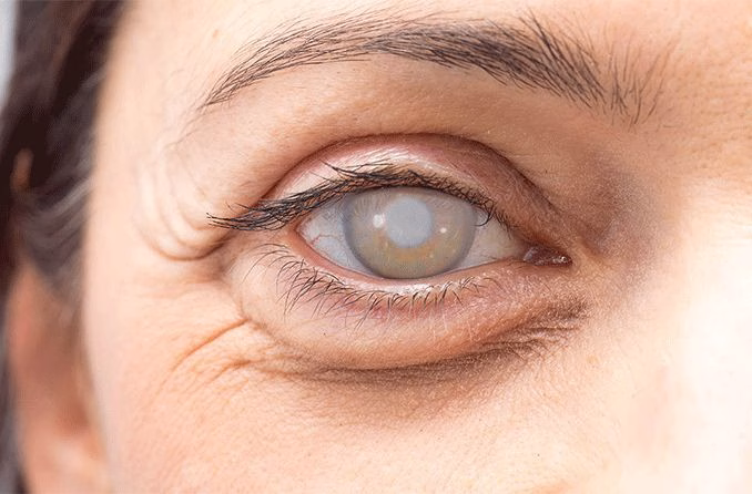 Cloudy Vision After Cataract Surgery