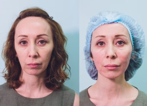 liquid facelift