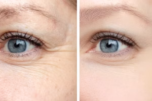 Laser Eye Blepharoplasty