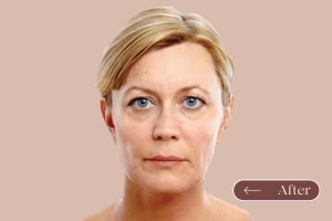 carbon laser facial carbon laser after