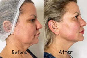 endolift2 Endolift Treatment in Flushing