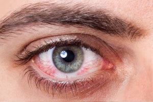 eye allergy