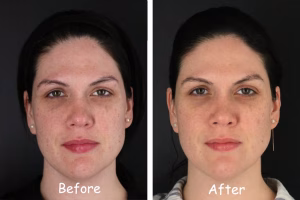 pico3 Picosure Laser Treatment