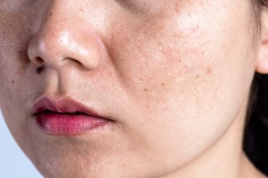 hhhkio Dark Spots and Pigmentation