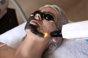 jj carbon laser facial benefits