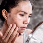 Dark Spot and Pigmentation