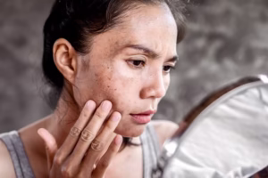 Dark Spot and Pigmentation