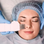 Laser Treatments for Acne Scars