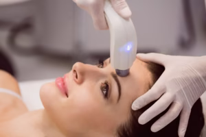 Laser Treatments for Acne Scars