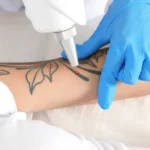 PicoSure Laser Tattoo Removal