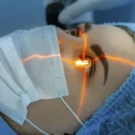 lasik eye surgery recovery