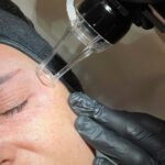 blepharoplasty laser