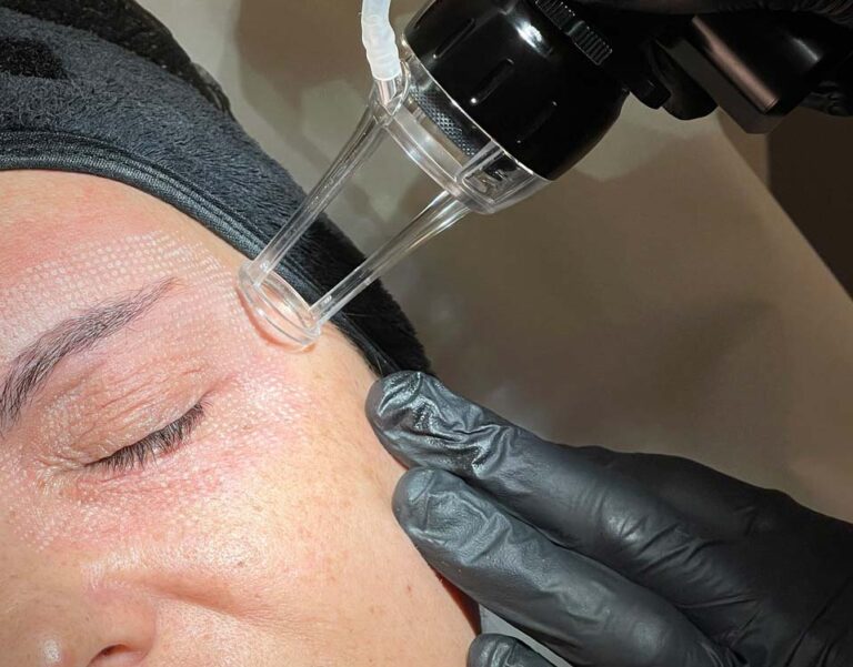 blepharoplasty laser