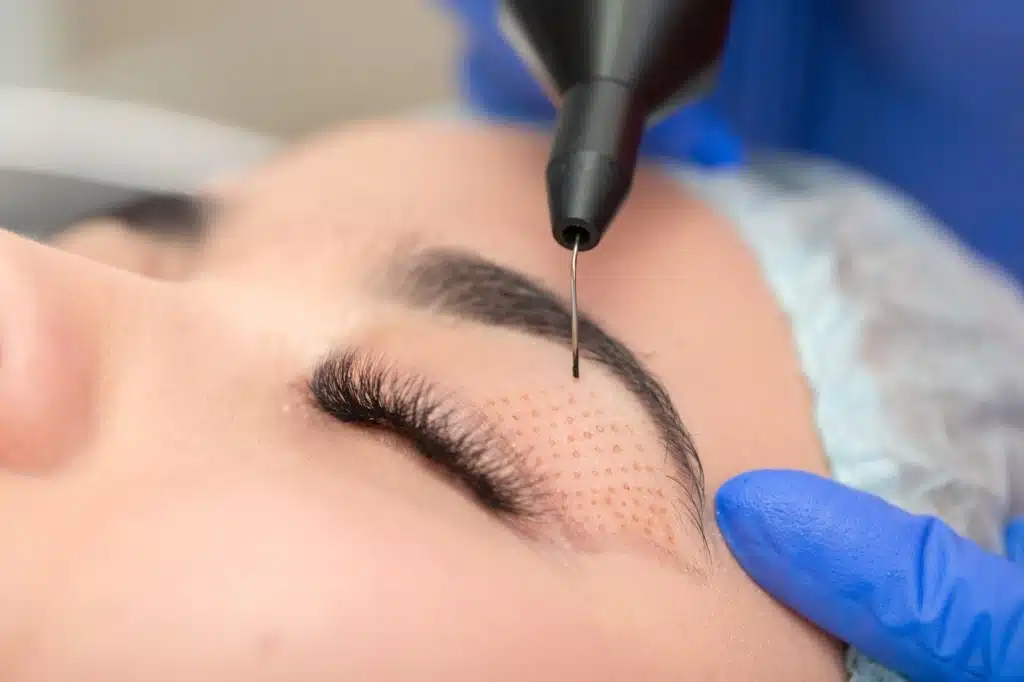 Laser Blepharoplasty in Flushing NY | Leevision