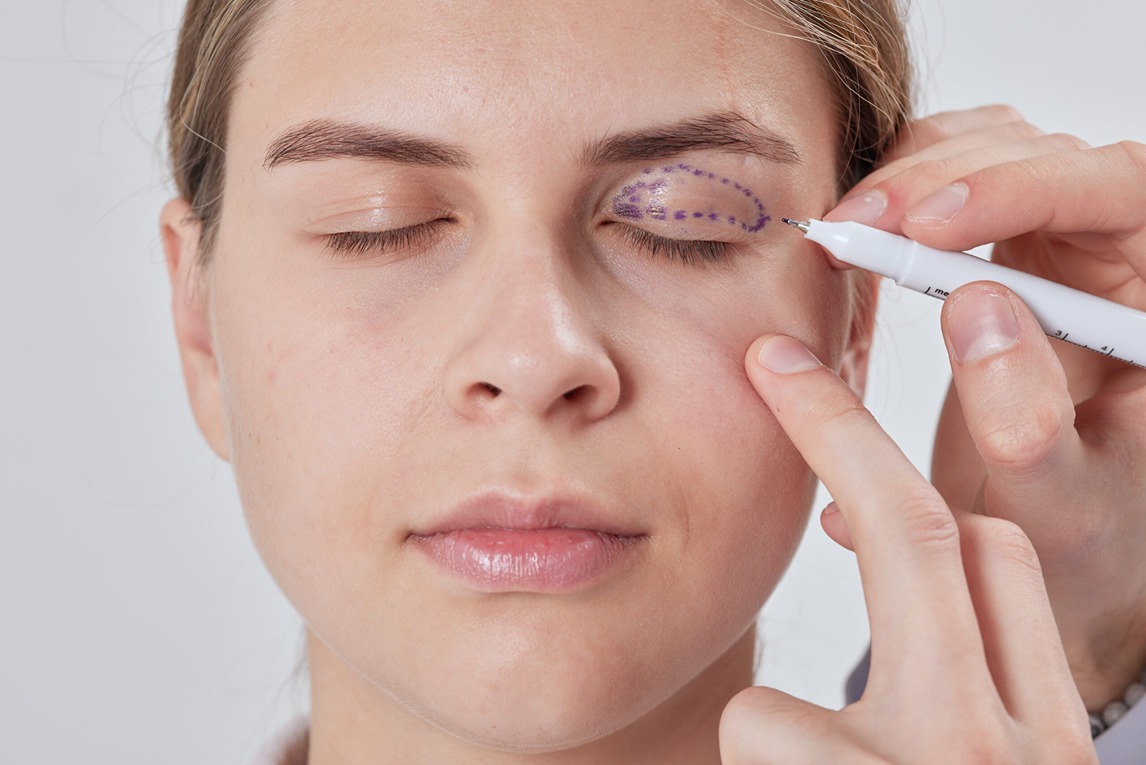 Laser Eyelid Lift