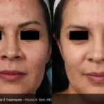 fractional CO2 laser treatment before and after skin rejuvenation results