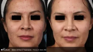 fractional CO2 laser treatment before and after skin rejuvenation results