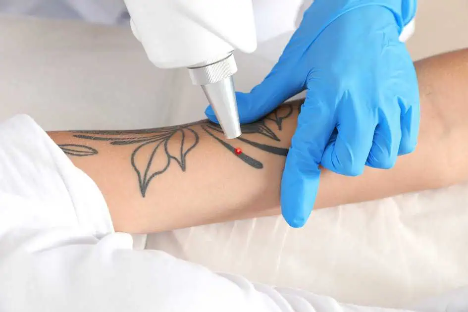 Laser tattoo removal on a forearm floral tattoo.