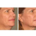 non surgical face lift procedure skin tightening