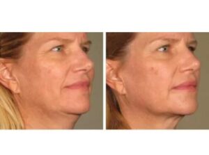 non surgical face lift procedure skin tightening