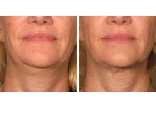 non surgical face lifting treatment before and after