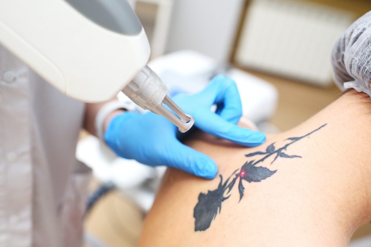 Laser tattoo removal on a shoulder rose tattoo.