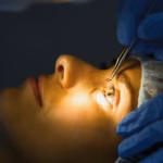 laser eye surgery recovery​