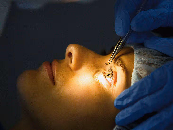 laser eye surgery recovery​
