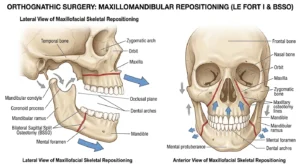 Double jaw surgery anatomical diagram upper and lower jaw repositioning Double jaw surgery anatomical diagram upper and lower jaw repositioning