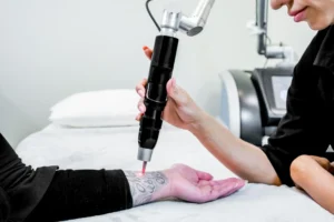 Laser tattoo removal machine in modern dermatology clinic