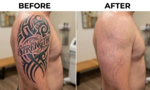 Tattoo laser removal before and after comparison showing a large black ink arm tattoo fading significantly after treatment.