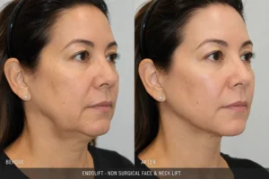 Before and after comparison showing natural jawline improvement after Endolift skin tightening treatment.