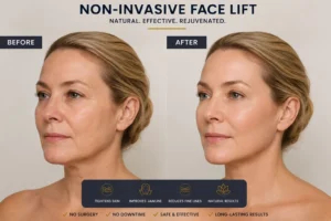 Non invasive face lift results after laser facial rejuvenation