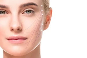 Endolift laser fiber under skin layers showing collagen stimulation and skin tightening process in a medical illustration.
